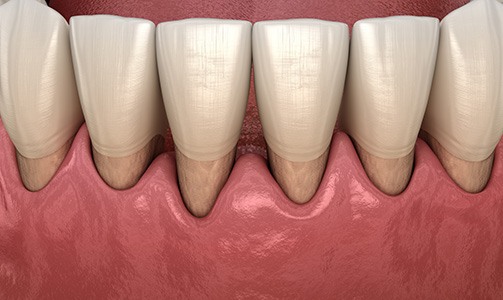 Gum disease is a bacterial infection of the gum tissue that may cause tooth loss or receding gums