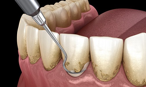 Scaling and root planing removes bacterial deposits from the teeth and gums