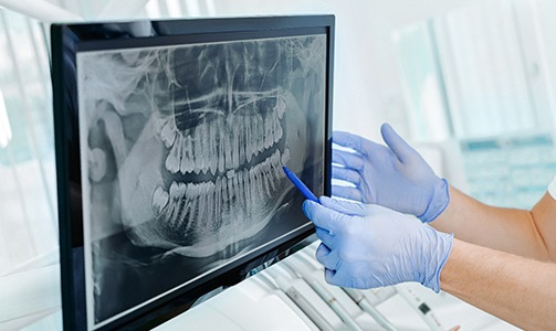 Idaho Falls implant dentist pointing to dental X-ray