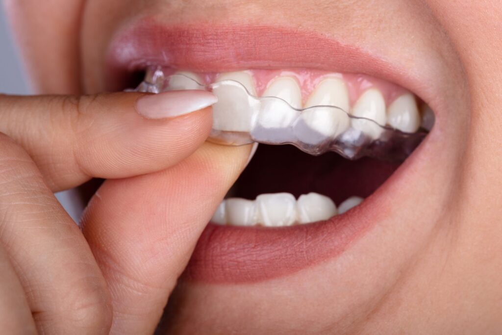 Closeup of woman inserting clear aligners over top arch